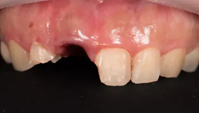 インプラント治療の症例