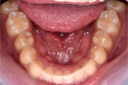 叢生（歯がガタガタ）治療後