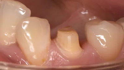 審美歯科の症例