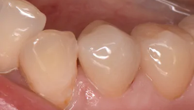 審美歯科の症例