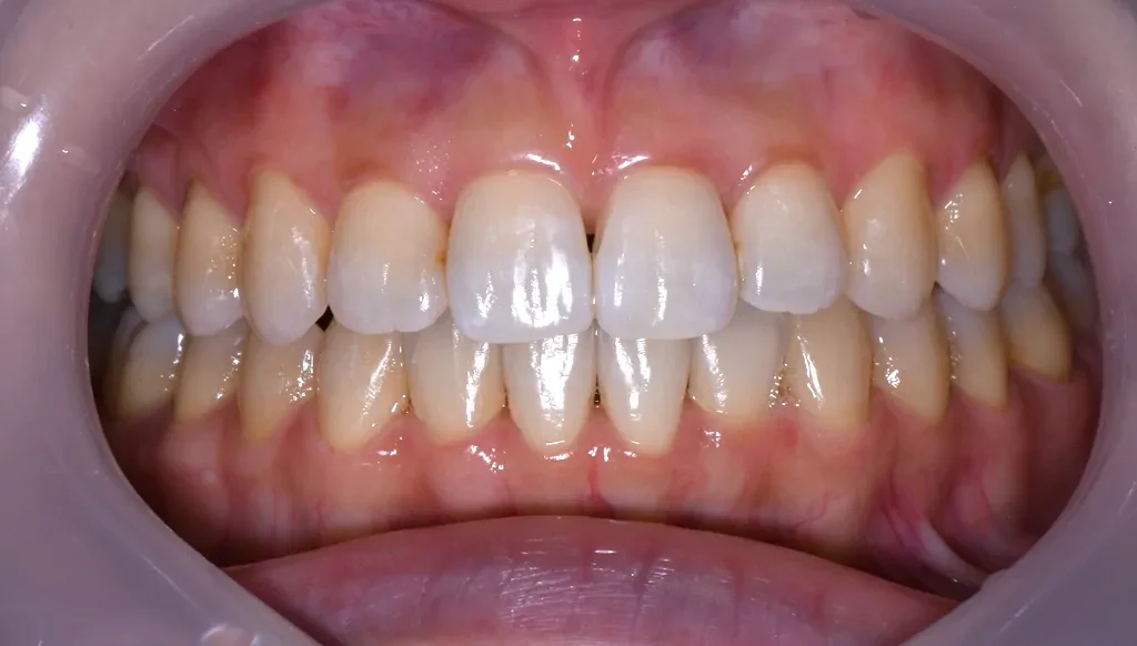 矯正歯科の症例