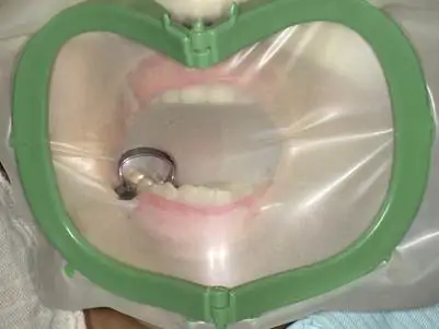 根管治療での感染への配慮