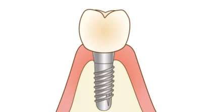 インプラント