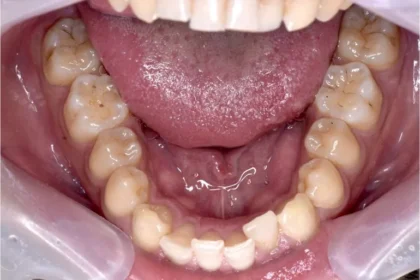 叢生（歯がガタガタ）治療前