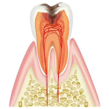 むし歯・歯周病の治療