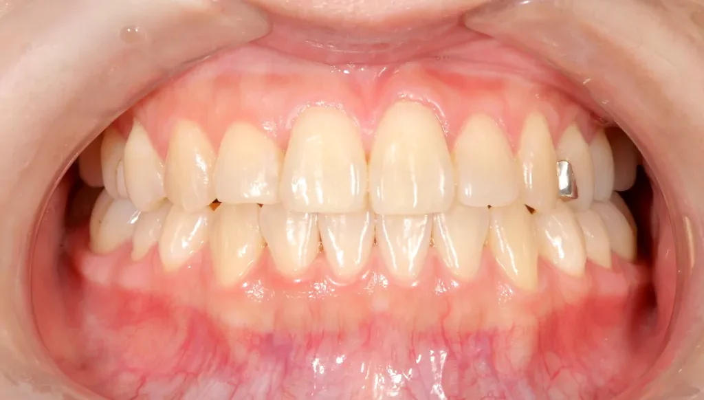 審美歯科の症例