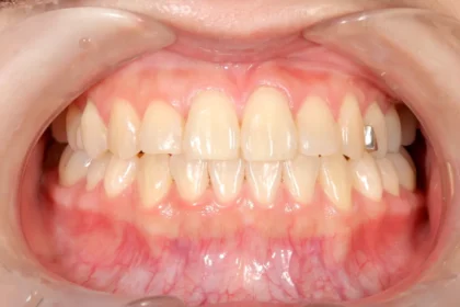 空隙歯列（すきっ歯）治療後