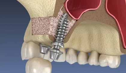 サイナスリフト