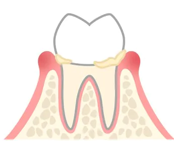 歯肉炎（しにくえん）