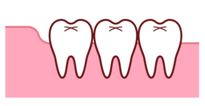 抜かなくてもよい親知らず