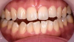 矯正歯科の症例