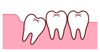 抜歯をおすすめする親知らず