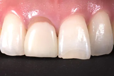 3.セラミッククラウン