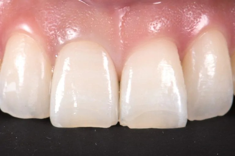 3.セラミッククラウン