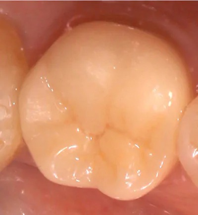 オールセラミッククラウン(ジルコニアフレーム+セラミック)