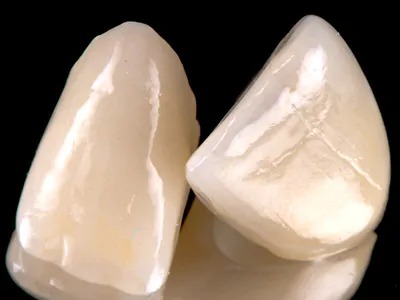 オールセラミッククラウン(ジルコニアフレーム+セラミック)