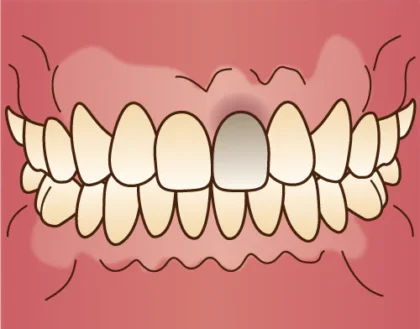 神経が死んでしまった歯のホワイトニング