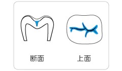 歯の溝はむし歯になりやすい