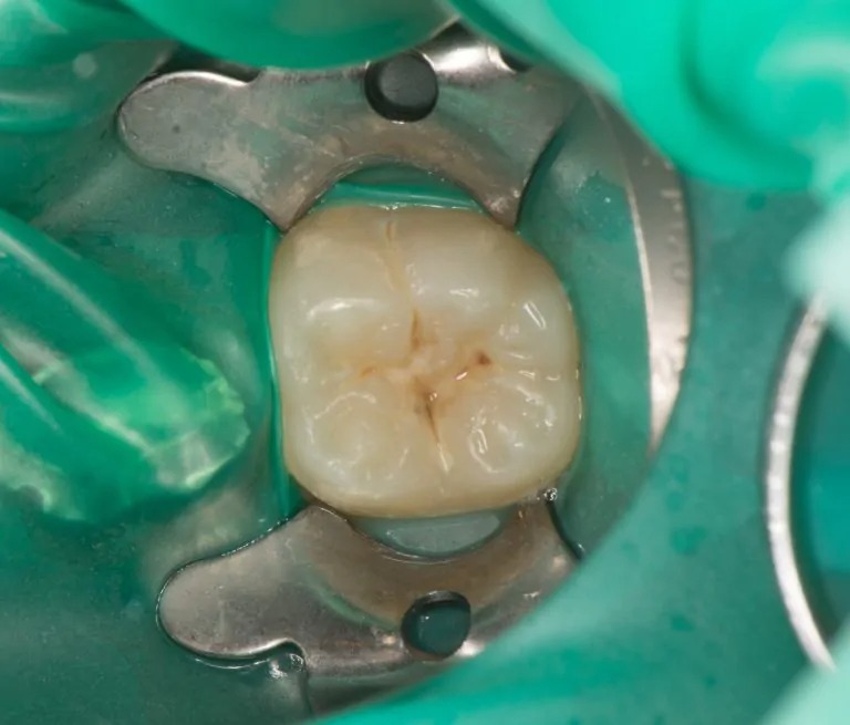 ラバーダム防湿といって処置中に唾（唾液）が入らない様にマスクをかけます