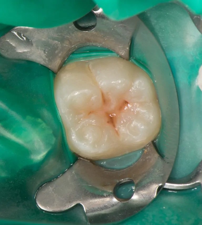 表面を綺麗にします（エッチング）