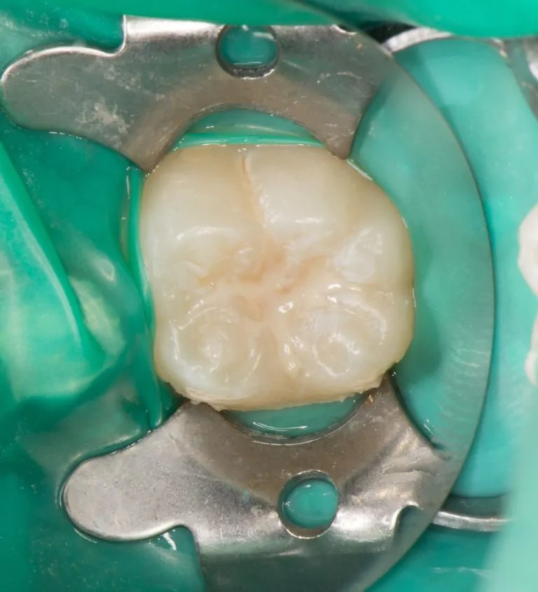 穴を埋めた（シーラント）ところ