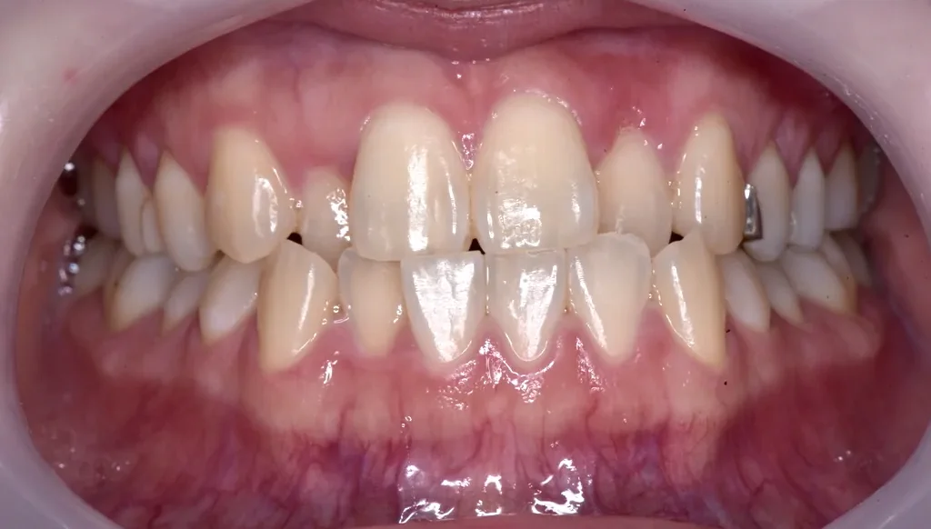 審美歯科の症例