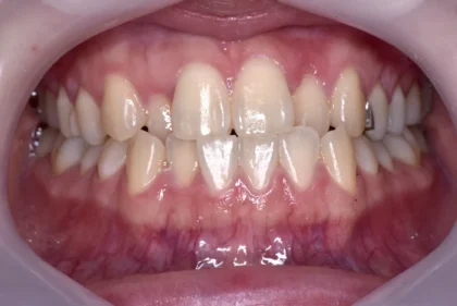 反対咬合（受け口）治療前