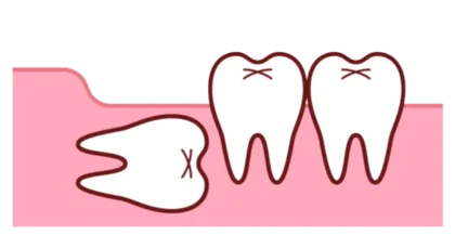 完全に歯ぐきや骨の中に埋まっている場合
