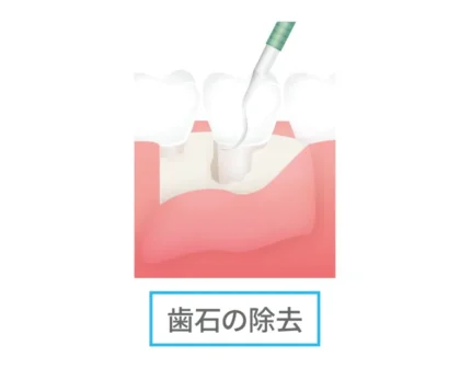 フラップ手術歯石除去
