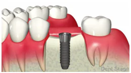 インプラント埋入