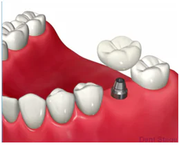 アバットメント装着と被せ物のセット