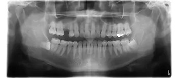 治療前:レントゲン