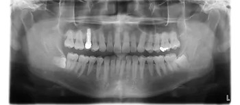 埋入後:レントゲン