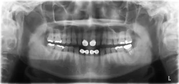 症例4治療前:レントゲン