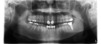 症例4治療後:レントゲン