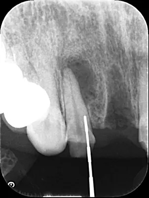 症例6:前歯審美インプラント計画時