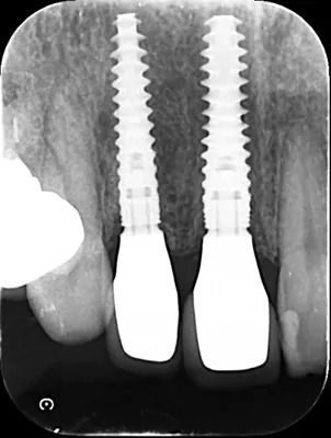 症例6:前歯審美インプラント埋入時