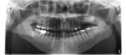 症例7:サイナスリフト治療前