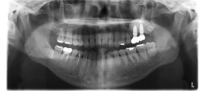 症例7:サイナスリフト治療中