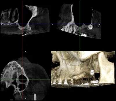 症例7:サイナスリフト治療後