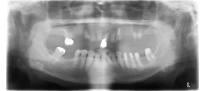 症例8:インプラントフルブリッジ治療前