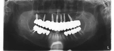 症例8:インプラントフルブリッジ治療後