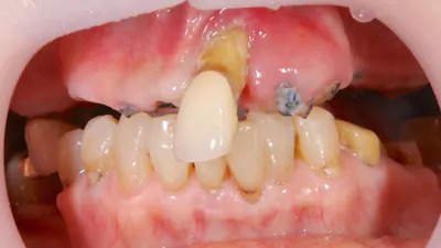 症例8:インプラントフルブリッジ計画時
