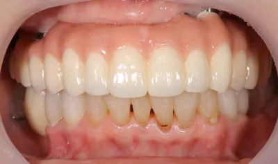 症例8:インプラントフルブリッジ埋入時