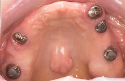 症例9:インプラントオーバーデンチャー2