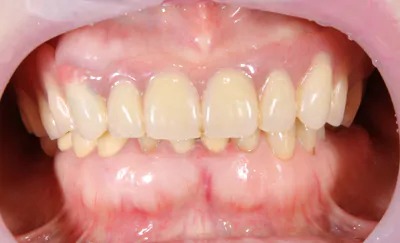 症例9:インプラントオーバーデンチャー3
