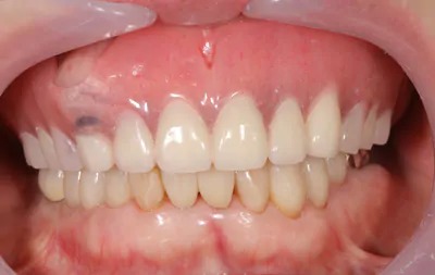 症例9:インプラントオーバーデンチャー4