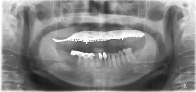 症例9:インプラントオーバーデンチャーレントゲン1