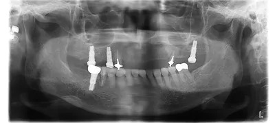 症例9:インプラントオーバーデンチャーレントゲン2