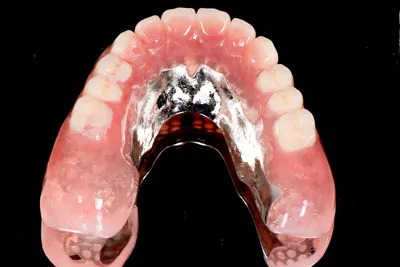 症例9:インプラントオーバーデンチャー